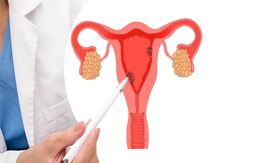 علائم پولیپ رحم