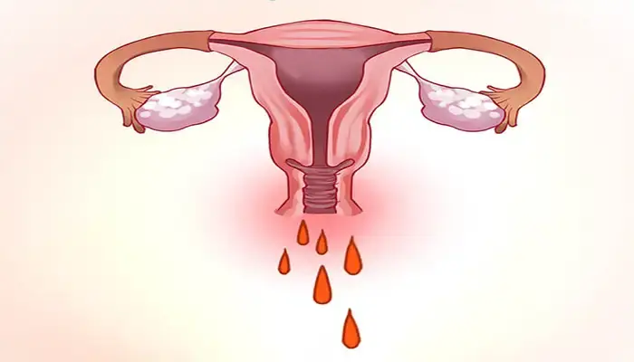 علت خونریزی رحم 