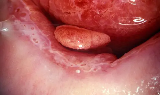 عکس پولیپ رحم