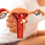 درمان آندومتریوز