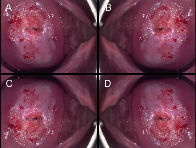 ضایعات دهانه رحم