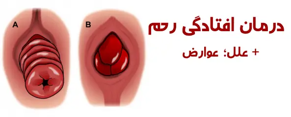 درمان افتادگی رحم