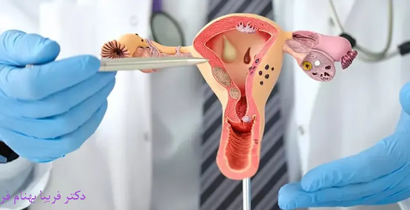 تخمدان پلی کیستیک