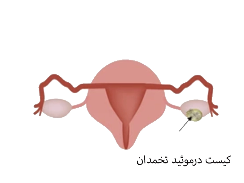 کیست درموئید تخمدان