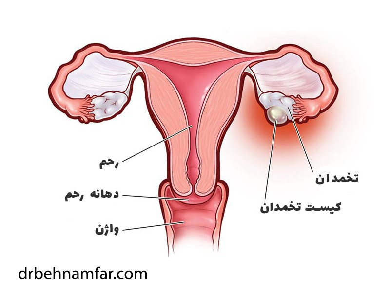 کیست تخمدان
